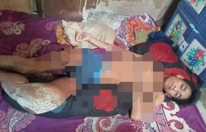 Karena Kekurangan Biaya, Penderita Tumor Ganas di Lutra Terpaksa Dirumahkan